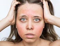 Modern Mindset: Amy Anderson on Rosacea Awareness